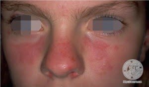 lupus